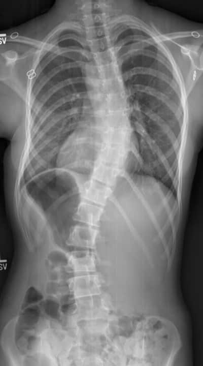 xray of curved spine with scoliosis