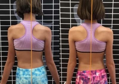 rita miller scoliosis therapy in southern idaho
